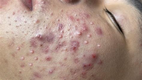 comdpB079CN61VT RESTMORE (30 Day) httpswww. . Youtube severe acne extraction